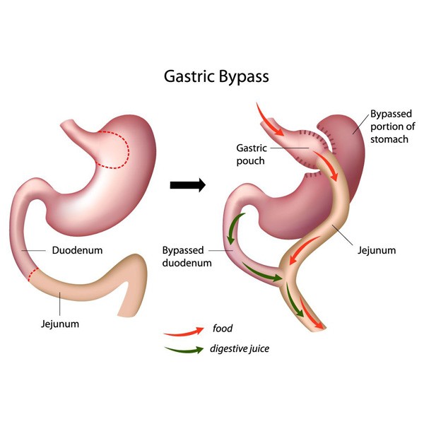 جراحی بای پس معده چگونه انجام می شود و چه مزایا و معایبی دارد