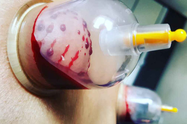 حجامت چگونه انجام می شود؟ انواع روش ها، عوارض و فواید آن