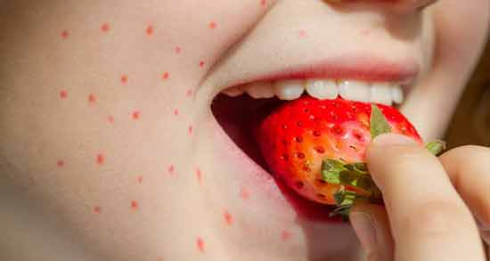 حساسیت توت فرنگی برای کودکان ؛ نشانه ها و علائم ایجاد حساسیت با خوردن توت فرنگی