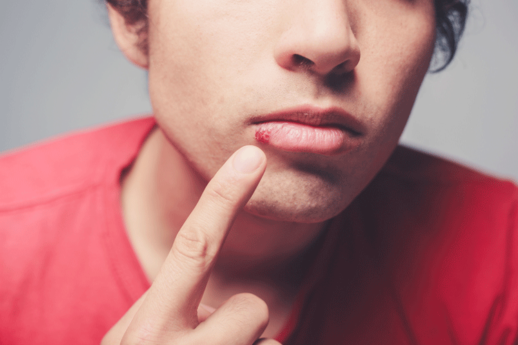 دلایل ایجاد تبخال لب | آیا واگیر دار است؟