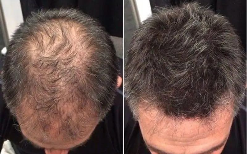 راهکاری دائمی برای مقابله با ریزش مو