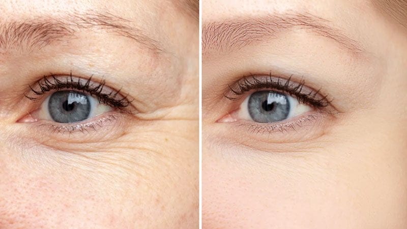روش های بوتاکس خانگی دور چشم با مواد طبیعی و درباره مزایا و معایب آن