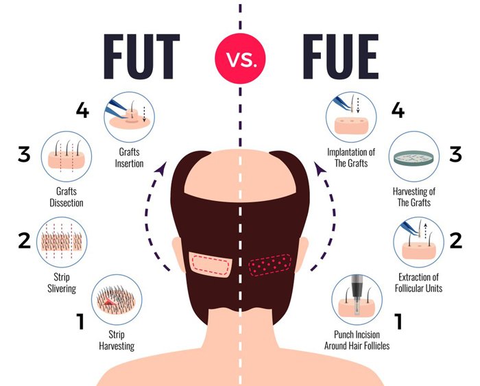 روش کاشت مو Super Fue Plus + مراحل انجام، عوارض و مزایای آن