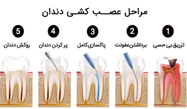 عصب کشی دندان | زمان انجام آن