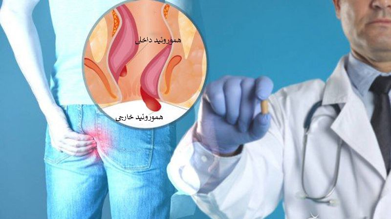 علائم بواسیر داخلی درجه ۱،۲،۳ و ۴ چیست؟ بهترین درمان هموروئید داخلی