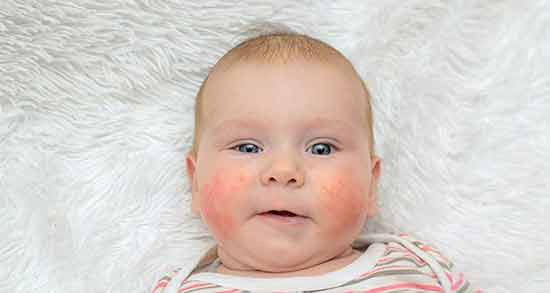 علائم حساسیت نوزاد به برنج نی نی سایت ؛ علائم و نشانه های حساسیت نوزاد به برنج چیست؟