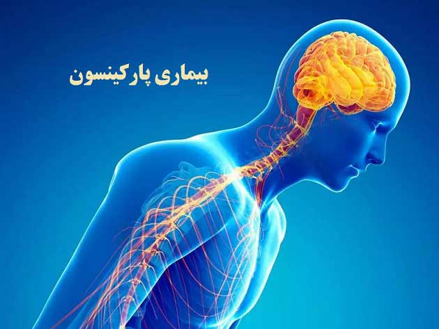 علائم پارکینسون؛ روش های پیشگیری و درمان این بیماری