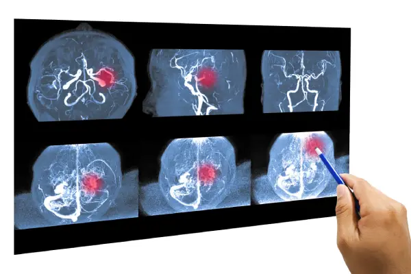 علائم پارکینسون؛ روش های پیشگیری و درمان این بیماری