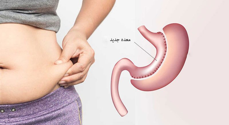 عمل بای پس معده برای لاغری (مزایا و معایب عمل کوچک کردن معده)