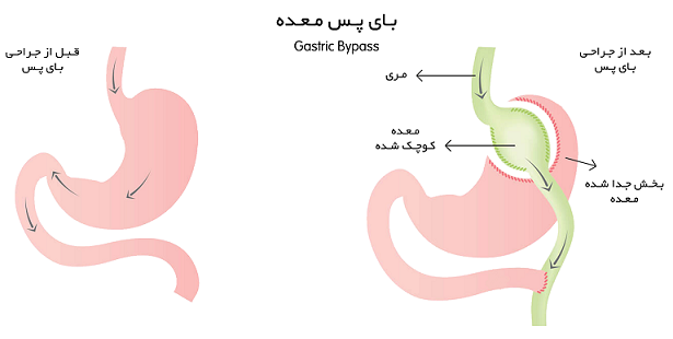 عمل بای پس معده برای لاغری (مزایا و معایب عمل کوچک کردن معده)