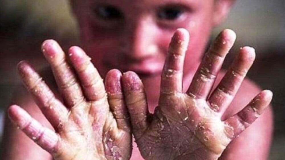 همه چیز در مورد بیماری پروانه ای؛ علائم، انواع بیماری و راهکارهای درمانی