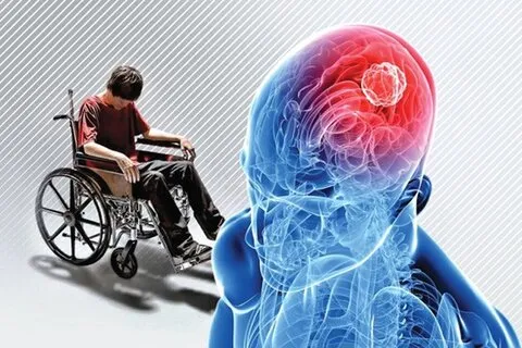 همه چیز درباره بیماری ام اس؛ علائم و نحوه درمان و راهکارهای کنترل MS