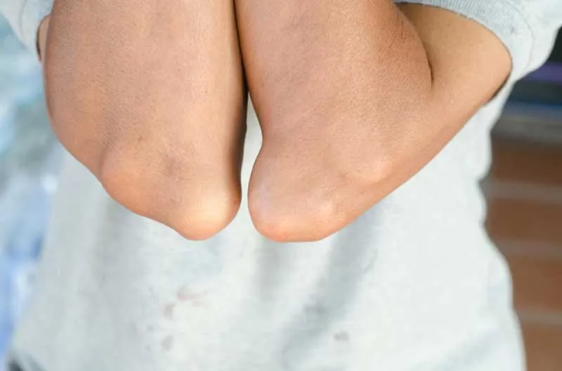 همه چیز درباره بیماری نقرس یا Gout (دلیل ایجاد، پیشگیری و درمان)