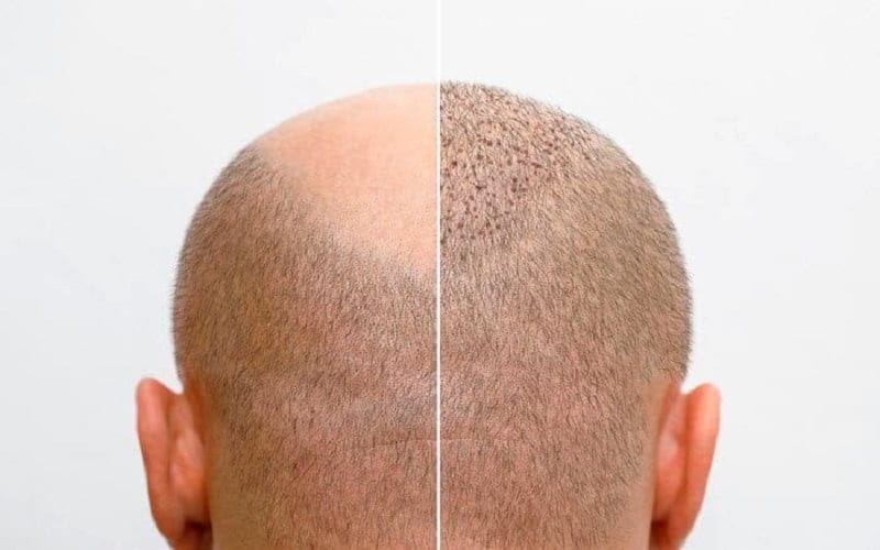 چرا هزینه کاشت مو در مناطق مختلف متفاوت است؟
