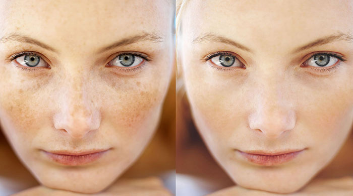 چگونه لکه های پوستی را با روش های خانگی درمان کنیم؟؛ درمان فوری لکه های پوستی چگونه لکه های پوستی را با روش های خانگی درمان کنیم؟؛ درمان فوری لکه های پوستی