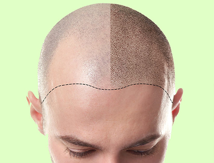 کاشت مو با روش BHT + مراحل انجام آن و مزایای و معایبی که دارد