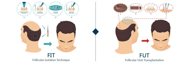کاشت مو به روش FIT ، اطلاعات کامل در مورد این روش، مزایا و معایب