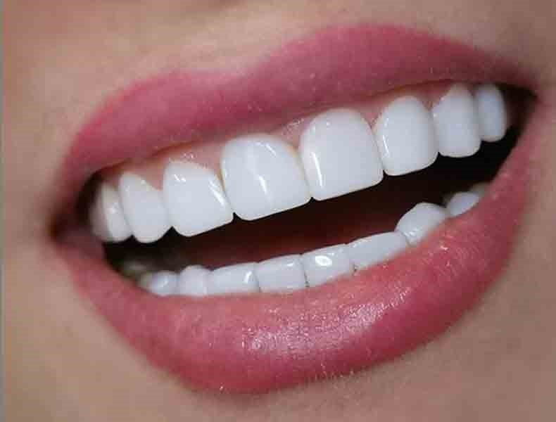 کامپوزیت دندان چیست؟ انواع ، مزیت ها و معایب آن