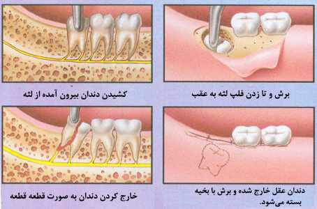 کشیدن دندان عقل | ضرورت کشیدن این دندان