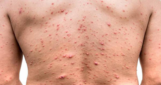 تعبیر خواب آبله ، مرغان گرفتن بچه از دید ابن سیرین در خواب و ابله مرغون کودک