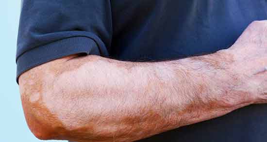 تعبیر خواب بیماری پوستی پیسی ، معنی بیماری پوستی پیسی در خواب های ما چیست