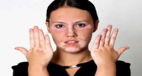 تعبیر خواب بیماری پیسی ، معنی بیماری پیسی در خواب های ما چیست