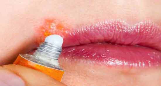 تعبیر خواب تبخال روی لب چیست ، معنی دیدن تبخال روی لب در خواب های ما چیست