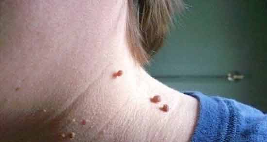 تعبیر خواب خال روی گردن ، معنی خال روی گردن در خواب های ما چیست