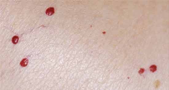 تعبیر خواب خال قرمز ، معنی خال قرمز در خواب های ما چیست