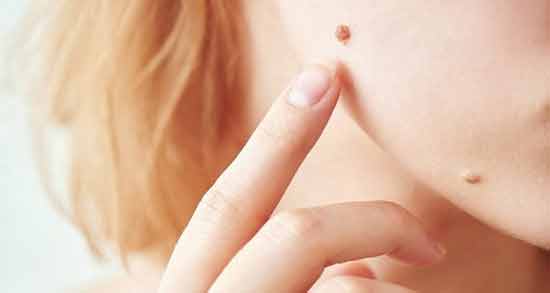 تعبیر خواب خال قهوه ای در صورت ، معنی خال قهوه ای در صورت در خواب های ما چیست