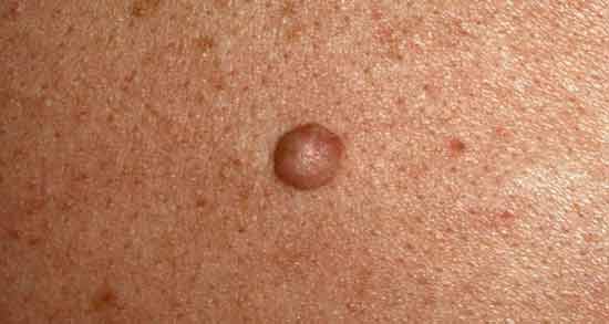 تعبیر خواب خال گوشتی روی پا ، معنی خال گوشتی روی پا در خواب های ما چیست