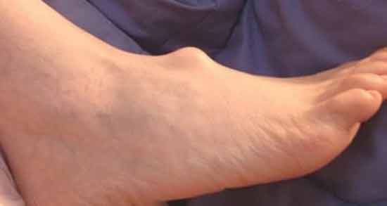 تعبیر خواب غده در پا ، معنی غده در پا در خواب های ما چیست تعبیر خواب غده در پا ، معنی غده در پا در خواب های ما چیست