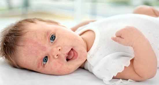 حساسیت نوزاد به فرنی نی نی سایت ؛ نشانه های حساسیت نوزاد به فرنی چیست؟