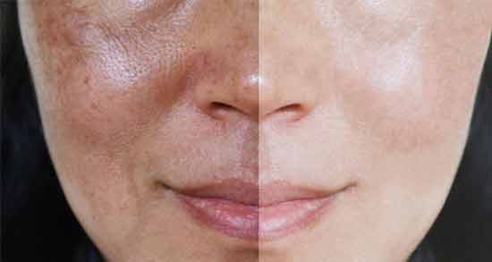طریقه مصرف روغن شترمرغ برای پوست صورت ؛ روش استفاده از روغن شترمرغ برای پوست