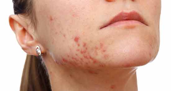 ماسک اسفرزه برای جوش صورت ؛ آموزش درست کردن ماسک اسفرزه برای درمان جوش