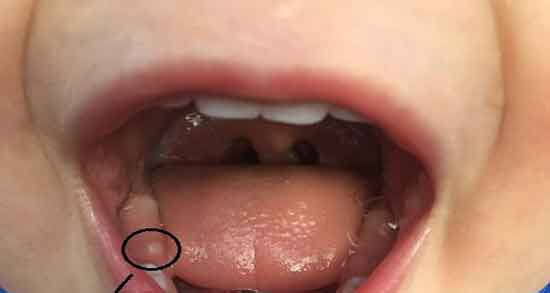 تعبیر خواب افتادن دندان اسیاب ، پایین و بالا در خواب بدون خونریزی کردن