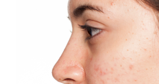 تعبیر خواب جوش زدن زبان و تاول زدن دهان و جوش چرکی در پشت کمر تعبیر خواب جوش زدن زبان ، معنی دیدن جوش زدن زبان در خواب های ما چیست