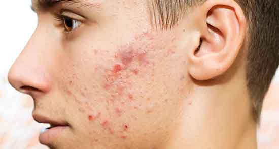تعبیر خواب جوش صورت ، مرده و دیگری و گردن و ترکیدن جوش چرکی روی کتف امام صادق