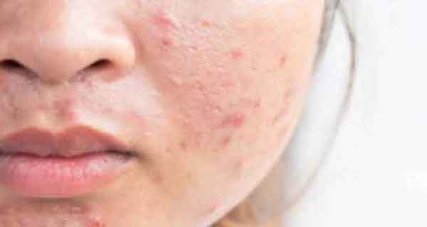 تعبیر خواب جوش صورت چرکی + تعبیر خواب جوش صورت دختر مجرد تعبیر خواب جوش صورت چرکی و جوش زدن کمر از نظر امام صادق