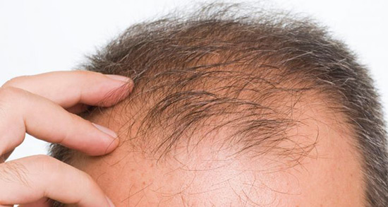 تعبیر خواب کچل شدن زن امام صادق ، حضرت یوسف و ابن سیرین و منوچهر مطیعی