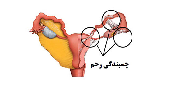 داروی اذخر و تباشیر ؛ درمان کیست تخمدان با تباشیر و اذخر تازه