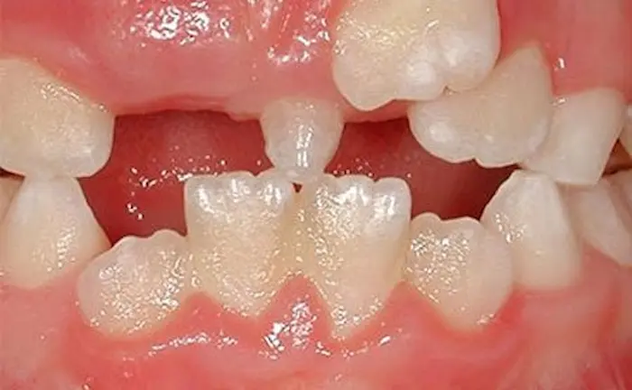 دلیل بیرون زدن دندان اضافه کودک (دلایل ایجاد دندان اضافه و درمان آن)