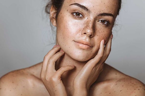 لک ملاسما چیست؟ روش‌های درمان آن و مراقبت های پوستی برای پیشگیری