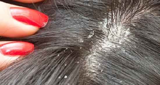 آب پیاز برای از بین بردن شپش ؛ درمان خانگی شپش با استفاده از آب پیاز