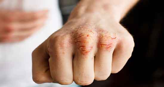 آب پیاز برای اگزما ؛ درمان سریع اگزما با استفاده از آب پیاز