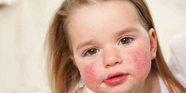 آلرژی غذایی کودکان؛ روش های تشخیص، علائم و مدیریت آلرژی نوزاد و کودک