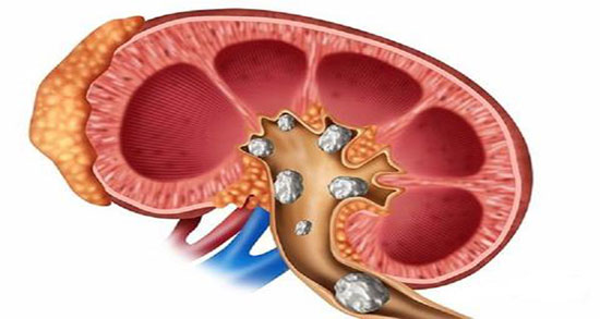 جوهر زنیان سنگ کلیه ؛ طریقه مصرف جوهر زنیان برای درمان سنگ کلیه