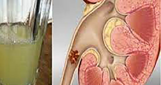 خواص جوهر زنیان برای سنگ کلیه ؛ خاصیت جوهر زنیان برای سنگ کلیه
