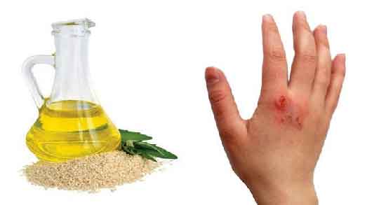 خواص روغن کنجد برای سوختگی ؛ تاثیر استفاده از روغن کنجد برای درمان سوختگی