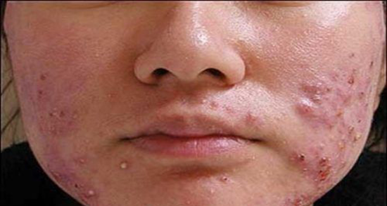 خواص زینک و روی ؛ خواص استفاده از زینک اکساید روی پوست صورت